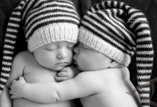 Orang Tua Bayi Kembar Siam Kesulitan Biaya Operasi Pemisahan Bayi Tersebut